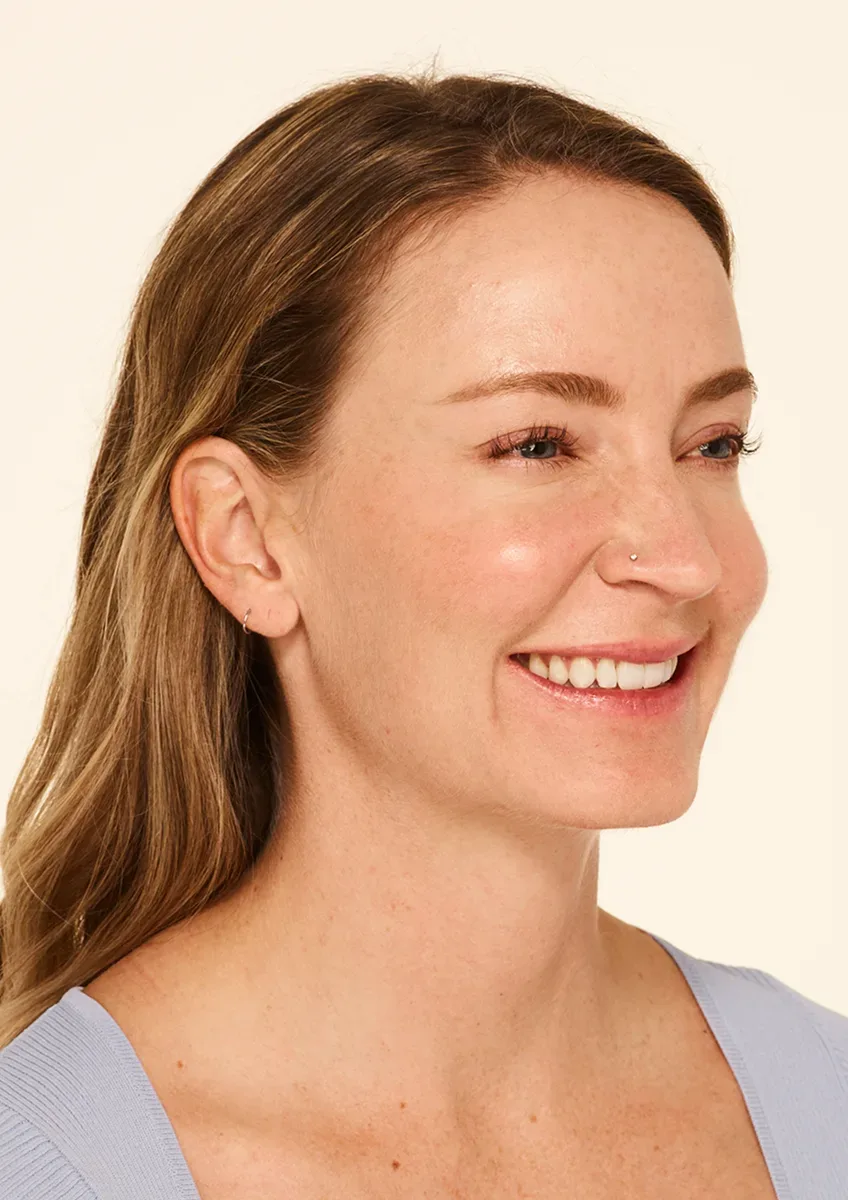Botox — after treatment