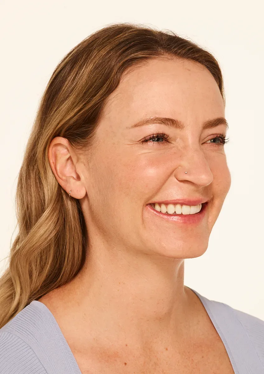 Botox — before treatment
