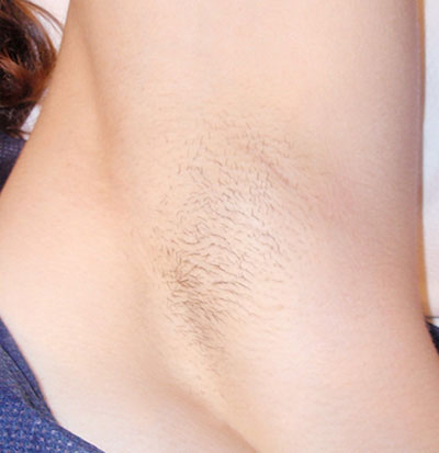 Laser Hair Removal — after treatment