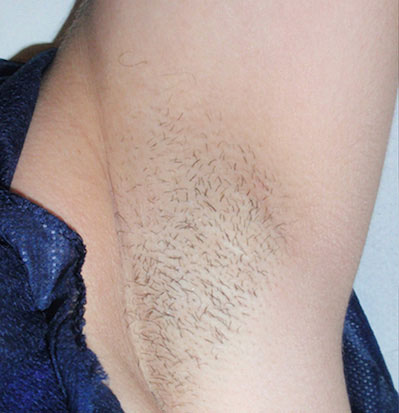 Laser Hair Removal — before treatment