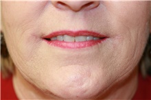 Lip Enhancement — after treatment