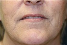 Lip Enhancement — before treatment