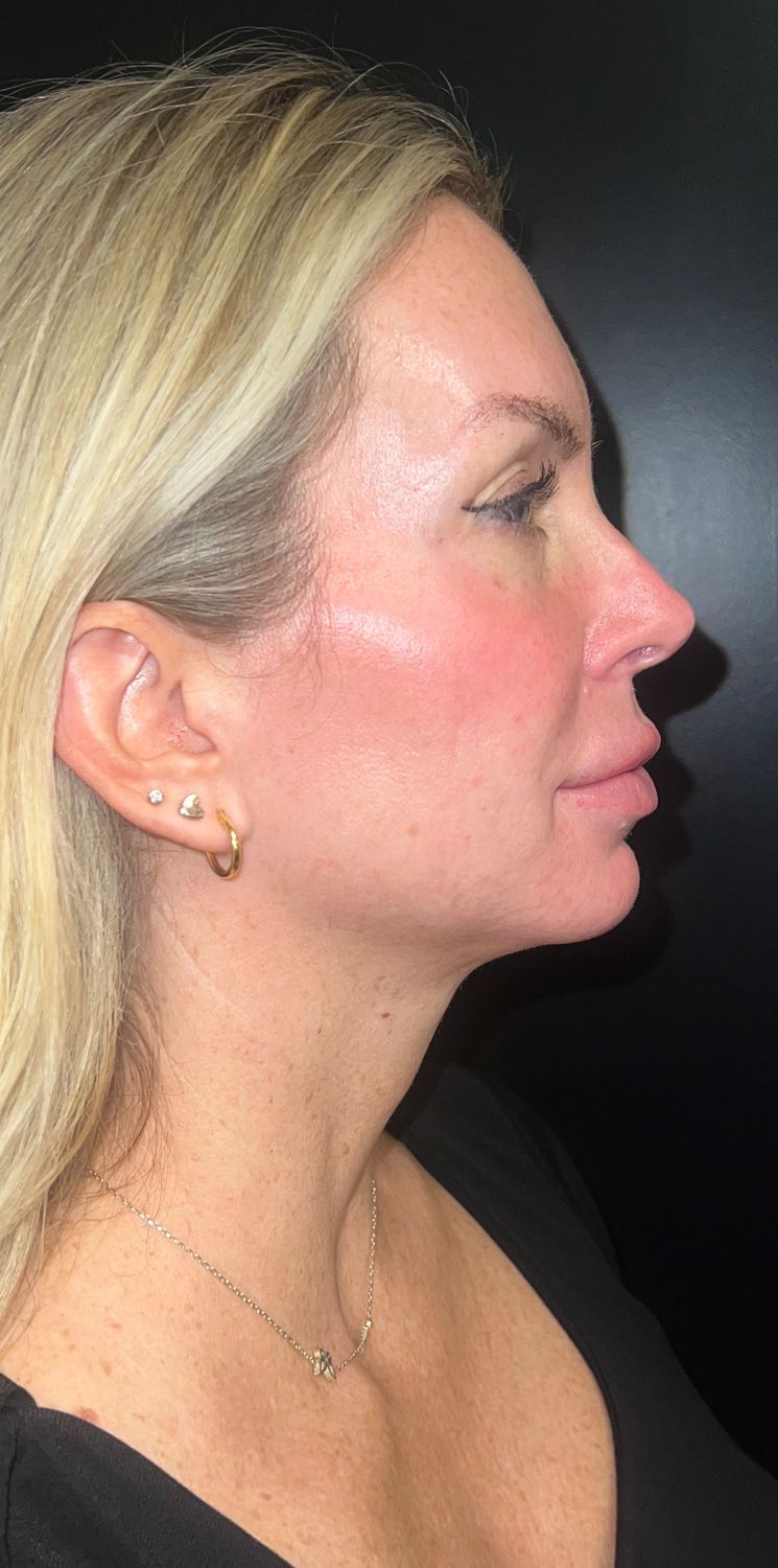 Morpheus8 — after treatment