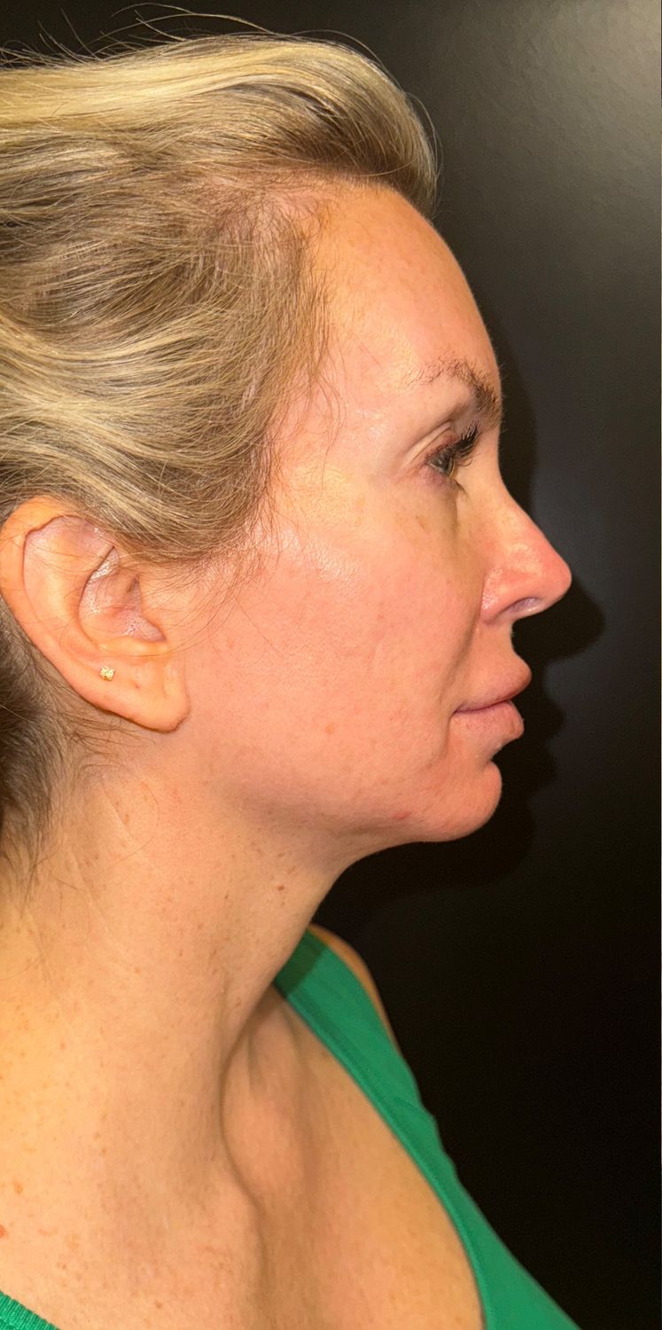 Morpheus8 — before treatment